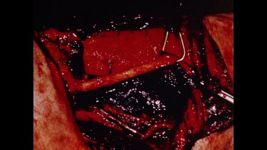 Rod Fox operating table