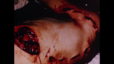 Rod Fox operating table