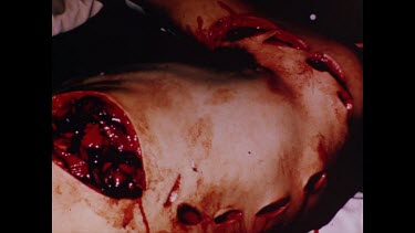 Rod Fox operating table