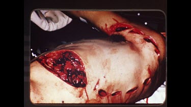 Rod Fox operating table