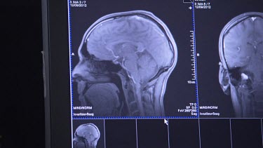 MRI scan of a patient's brain